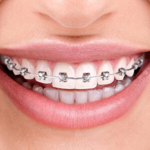 Imagem de uma mulher sorrindo com aparelho ortodontico