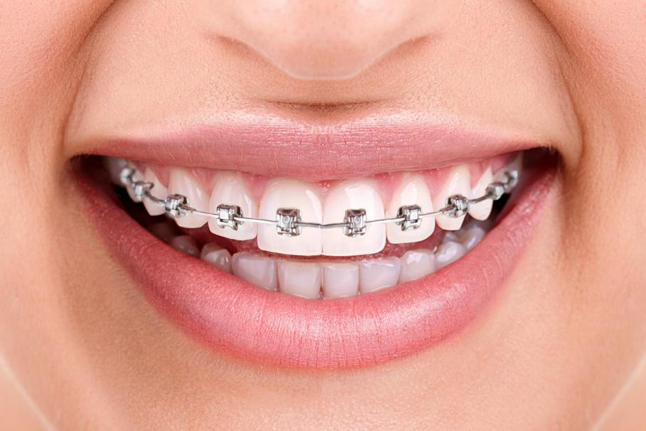 Imagem de uma mulher sorrindo com aparelho ortodontico