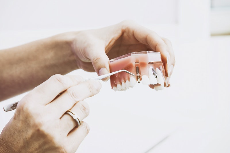 Imagem de um dentista mostrando o modelo de uma boca com implante dentário