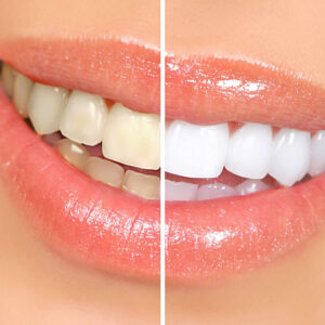 Imagem de uma mulher sorrindo com metade dos dentes amarelados e a outra metade com clareamento dental