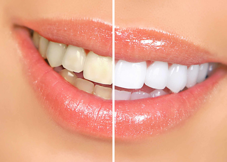 Imagem de uma mulher sorrindo com metade dos dentes amarelados e a outra metade com clareamento dental