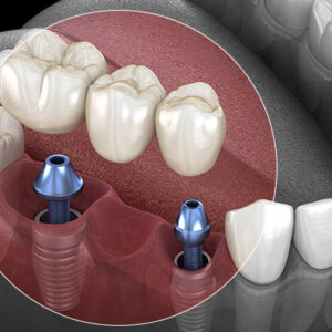 Ilustração de uma boca com implante dentário