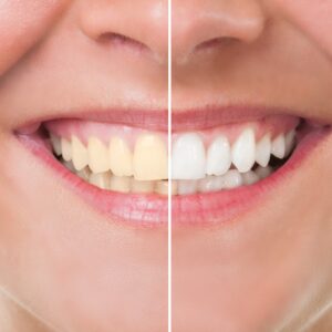 Imagem de uma mulher sorrindo com metade dos dentes amareladose a outra metade branco