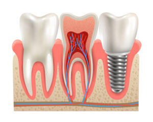 imagem vetorizada de um implante dentário