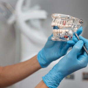 A imagem mostra um implante dentário