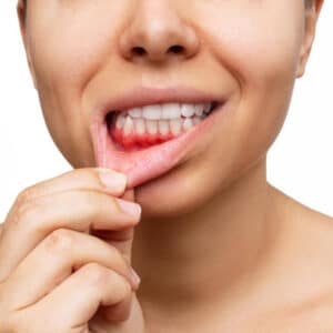 Inflamação da gengiva. Foto recortada de uma jovem mostra gengivas sangrando vermelhas puxando o lábio