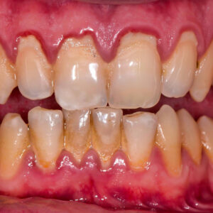 gengiva apresentando sinais de doença